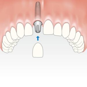 tek diş implant